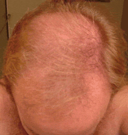 FOLIGAIN Low Alcohol Minoxidil 5% Hair Regrowth Treatment For Men 3 Month Supply - FOLIGAIN EUROPE