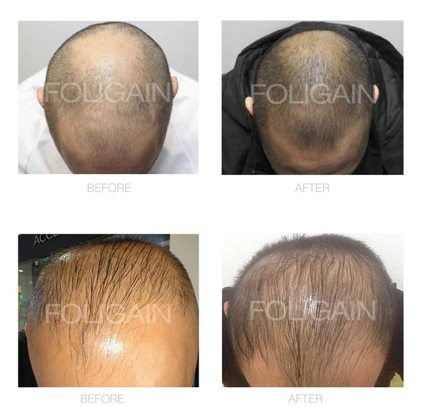 FOLIGAIN Advanced Hair Regrowth For Men Minoxidil 5% + Trioxidil 5% - FOLIGAIN EU