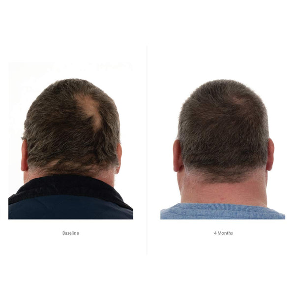 FOLIGAIN Triple Action Conditioner voor dunner wordend haar voor mannen met 2% Trioxidil